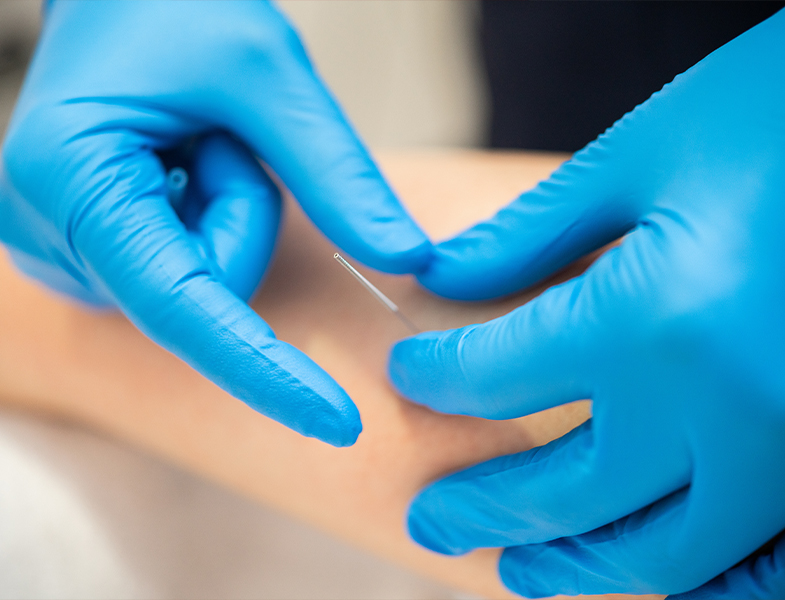 Specialist administering dry needle therapy